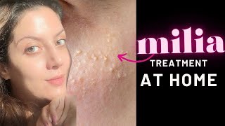 Are you suffering from bumpy skin under eyes What is Milia I How to treat Milia [upl. by Lidah390]