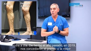 Láser endovenoso para varices en Dermitek [upl. by Swanson]