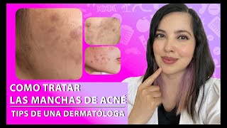 ¿Tienes MANCHAS POR ACNÉ Tips de una Dermatóloga 👩🏻‍⚕️👌🏻 [upl. by Marlen178]