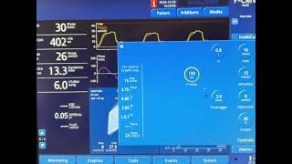 Understanding Ventilator Graphics Short Rise Time amp Pressure Overshoot [upl. by Tricia]