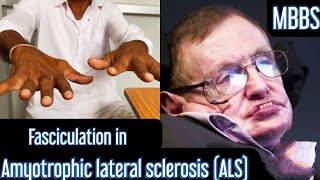 Fasciculation in Amyotrophic lateral sclerosis ALS mbbs medicine neet usmle aiims next [upl. by Atnauqal153]