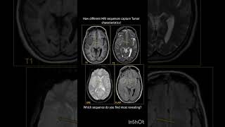 How different MRI sequences highlight tumor characteristics [upl. by Jempty]