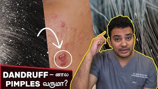 Dandruff  னால Pimples வருமா  Dr Sethuraman  ZI Clinic [upl. by Asiak]