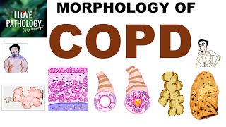 COPD Morphology Review  Emphysema Chronic Bronchitis Bronchiectasis Asthma  Exam Prep [upl. by Einned797]