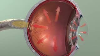 Animation Glaucoma [upl. by Kronfeld]