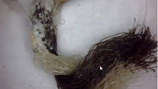 Morgellons Disease What is it  Morgellons is A Fungi  More Update [upl. by Sydalg]