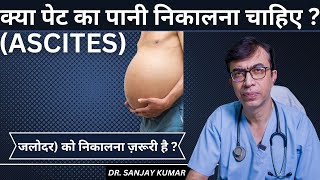 क्या पेट का पानी Ascites निकालना चाहिए   जलोदर को निकालना ज़रूरी है [upl. by Yrek]