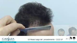 Alopecia grado 3 Vertex [upl. by Atteuqnas428]