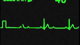 2nd Degree 21 AV Block  ECG Simulator  Arrhythmia Simulator [upl. by Ecinrev]