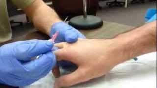 How to start an IV Dorsum of hand [upl. by Hgielhsa685]