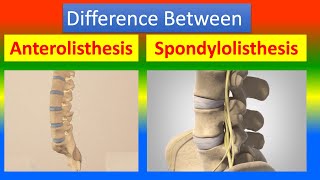 Distinction Between Anterolisthesis and Spondylolisthesis [upl. by Reklaw]