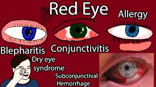 Red Eye Causes Symptoms and Treatment Pink eye causes [upl. by Vitia]