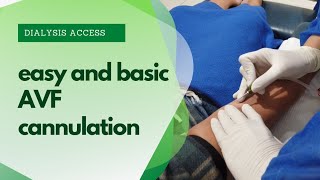 AVF Cannulation Video  Cannulating Easy and Basic AVF access [upl. by Luce]