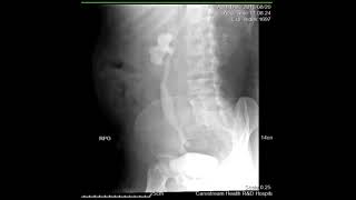 CASE REVIEW intravenous pyelography IVP [upl. by Meelas]