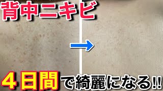 市販の薬を使わずに背中ニキビを治した方法 （赤ニキビ、白ニキビ、黒ニキビ） [upl. by Eiznil]