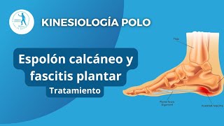 Espolón calcáneo y Fascitis plantar — Tratamiento [upl. by Fryd]