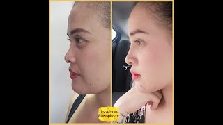 LipoMatrix Rhinoplasty by Dr Claudine Roura explained [upl. by Jane]