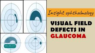 FIELD DEFECTS IN GLAUCOMA  arcuate paracentral nasal step temporal wedge baring of blindspot [upl. by Aillimat647]