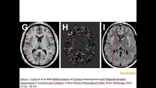 38 MOGHE mild malformation oligodendroglial hyperplasia ILAE classification 2022 epilepsy [upl. by Vernita277]