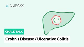 Crohn’s disease and ulcerative colitis Differences [upl. by Marty]