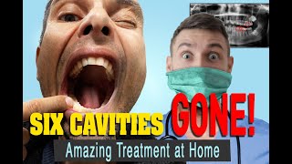 The Treatment for Tooth Decay that Reversed my 5 Cavities in 3 Months [upl. by Yert]