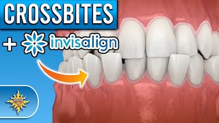 Teeth Open Bite Closed Aesthetically with Braces Before And After  Braces Journey [upl. by Stephi]