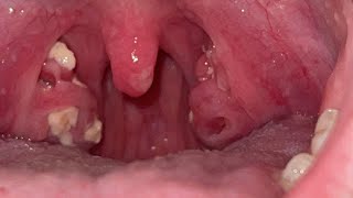 how to get rid of tonsil stones deep in the throat in only 2 minutes [upl. by Lyons]