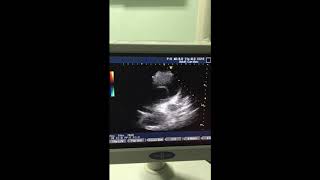 Huge ascending aorta with dissection flap from right parasternal view [upl. by Arahahs]