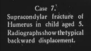 Recent advances in fracture treatment Part 5 c1932 [upl. by Rennug947]