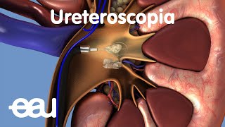 Tratamiento de cálculos renales y ureterales URS [upl. by Kram]