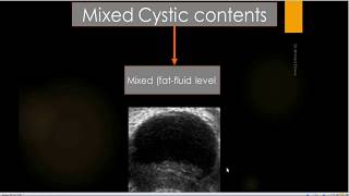 all things adnexal ovarain mass Imaging IOTA algorithm ACR ORADS GIRADS [upl. by Neened]