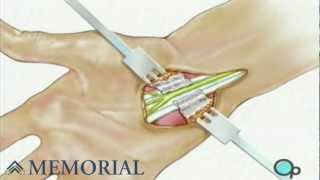 Carpal Tunnel Syndrome Repair Surgery [upl. by Wilde131]