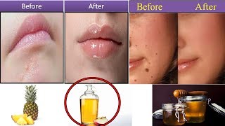 Top 5 Wasy To Get Rid of Flat Warts on Face Using Home Remedies [upl. by Viki]