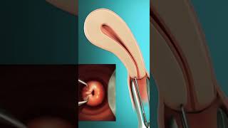 IUD insertion How to prevent pregn🤰 [upl. by Ellehcil]