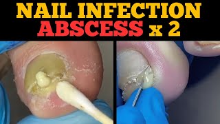 Ingrown Nail Infection Abscess  Second Nail Will Shock You [upl. by Mazurek]