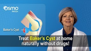 Bakers Cyst Treatment  What you need to know [upl. by Javed873]