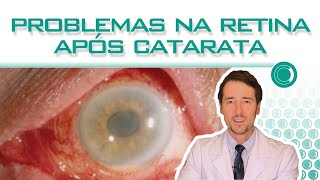 Problemas na retina após catarata  o que fazer [upl. by Krug]