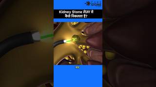 Kidney stone treatment  Retrograde Intrarenal Surgery  RIRS  किडनी स्टोन का इलाज shorts [upl. by Roeser]