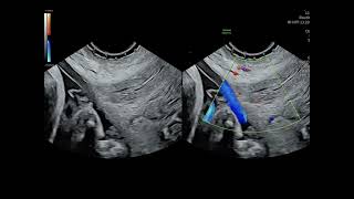 Challenging common misconceptions in vasa previa screening and diagnosis [upl. by Hairu]