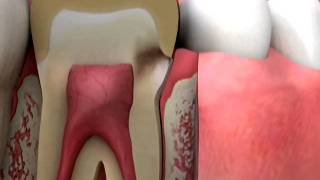 Crowns Margin Decay Diagnosis [upl. by Nerej94]