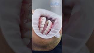 Complex Full Mouth Rehabilitation with Dental Implants and Dental Crowns  Dr Rami Albahri [upl. by Niki687]