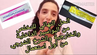 الوصفة المعجزة لعلاج البواسير و الشرخ الشرجي من اول استعمال [upl. by Chema346]