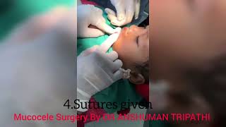 Mucocele Surgery in a 5 year old Nepalese girl child👍😊 dranshumantripathi3599 [upl. by Ettenad]