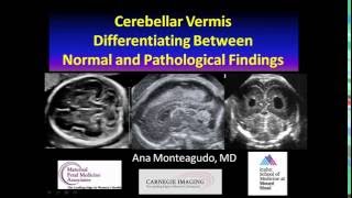 AIUM Webinar Cerebellar Vermis [upl. by Idnaj4]