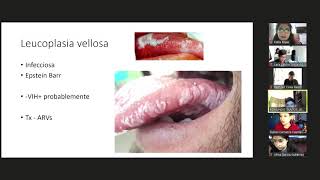 Queratosis del Fumador Estomatitis Actinica Leucoplasia Lique Plano [upl. by Vale]