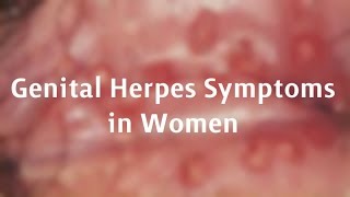 Genital Herpes Symptoms in Women [upl. by Vaenfila]