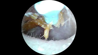 I found THIS in my EAR  Ear wax Removal Camera [upl. by Aedni]