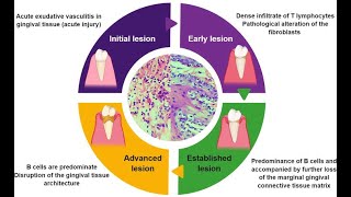 Periodontal Pathogenesis  Part 1 [upl. by Ynoep]