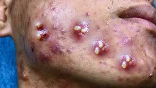 Big Cystic Acne Blackheads Extraction Blackheads amp Milia Whiteheads Removal Pimple Popping [upl. by Keefe]