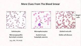 Anemia Lesson 4  Clues from the blood smear [upl. by Viglione]